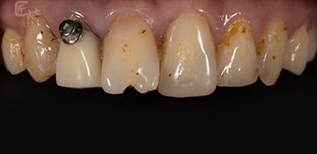 齒色泛黃、顏色不均、牙齒反覆補牙