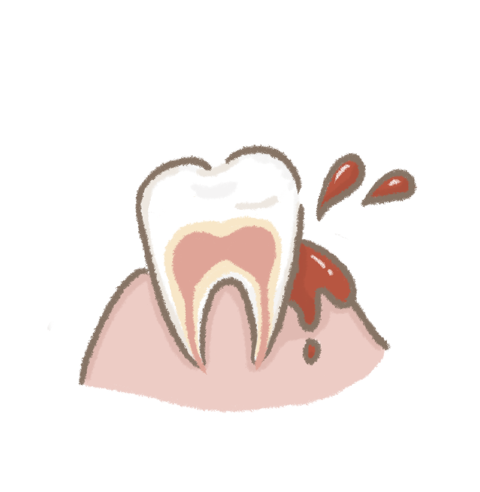 牙齦流血
