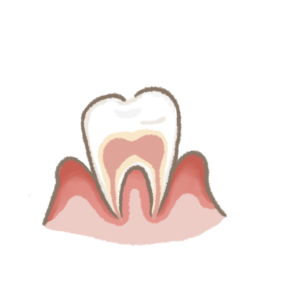 牙齦紅腫