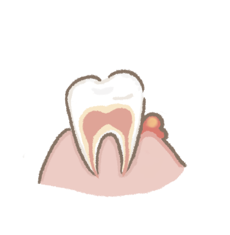 長芽苞（牙周膿腫）
