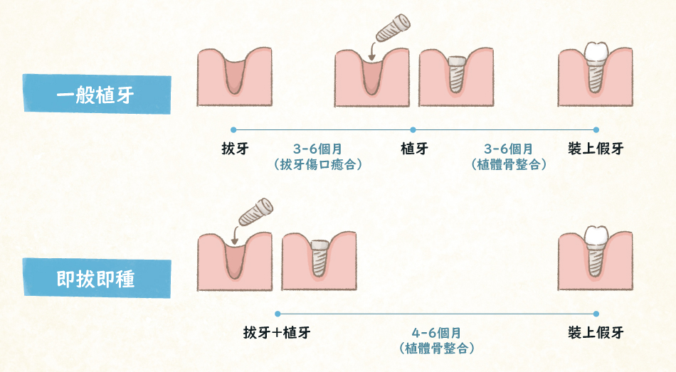 圖解“即拔即種”及“一般植牙”的差別?