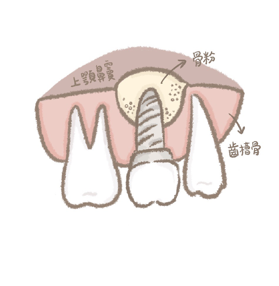 鼻竇增高術