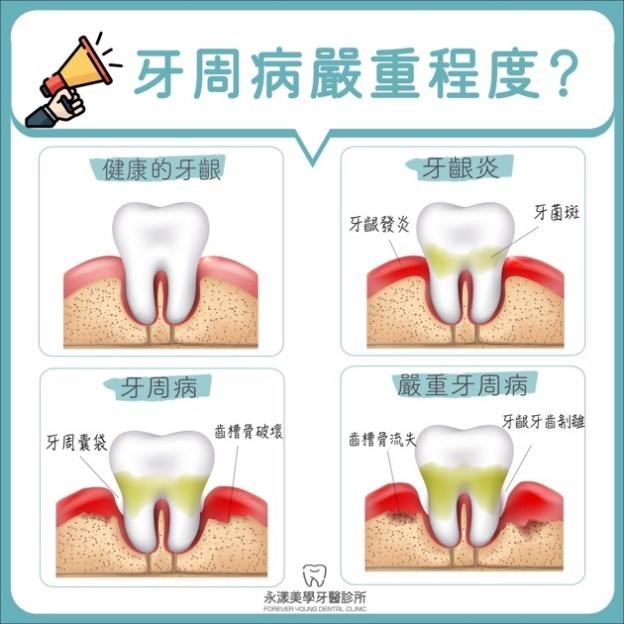 我的牙周病算嚴重嗎?