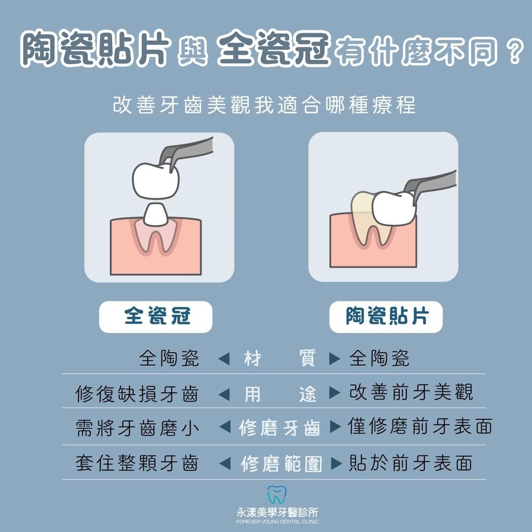 陶瓷貼片與全瓷冠有什麼不同?